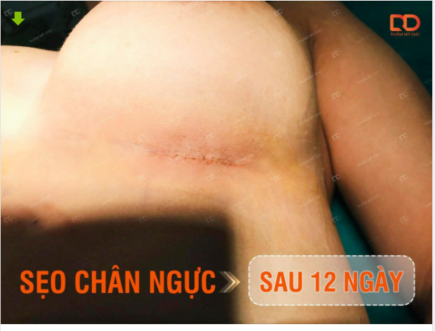 Chia sẻ với các nàng kết quả thực tế vết mổ chân ngực sau 12 ngày. Với những người cơ địa tốt thì sẽ mờ sẹo rất nhanh.