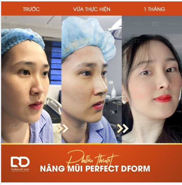 Có ít nhất 3 lý do để bạn lựa chọn Nâng mũi Perfect Dform