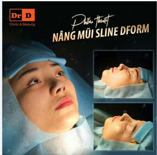 Có nên lựa chọn thực hiện dáng mũi Sline Dform không?