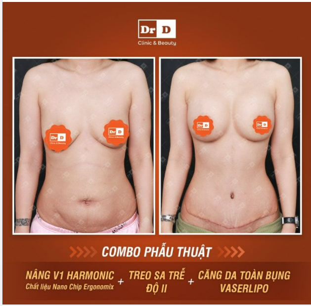 Có thực hiện Combo Nâng V1 Harmonic + Treo sa trễ + Căng da bụng VASERlipo trong cùng 1 lần được không?