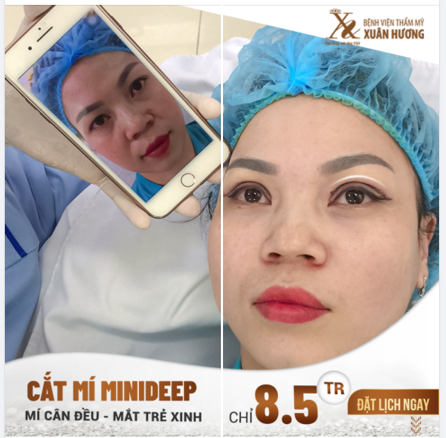 "CÓ TỚI 10/10 KHÁCH HÀNG HÀI LÒNG SAU KHI CẮT MÍ TẠI BVTM XUÂN HƯƠNG"