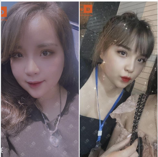 Combo Nâng mũi, Cắt mí đã bước qua năm thứ 4