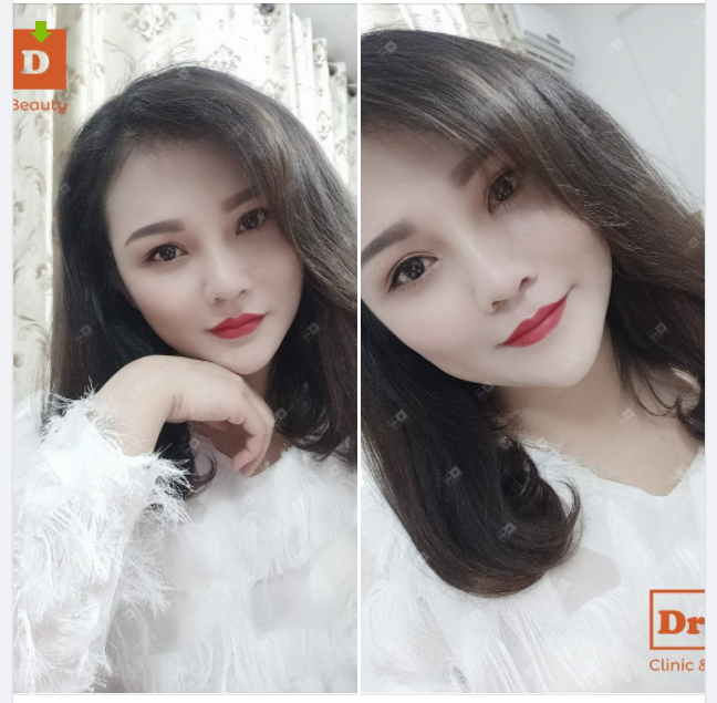 Combo Nâng mũi Cắt mí vẫn luôn là dịch vụ hot nhất tại DrD. Và đây là kết quả ca combo sau 5 năm, vẫn đẹp tự nhiên và nàng khách vẫn rất ưng ý.