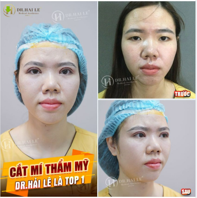 9/10 khách hàng phản hồi "không đau - hài lòng" sau khi thực hiện cắt mí thẩm mỹ tại Dr.Hải Lê!