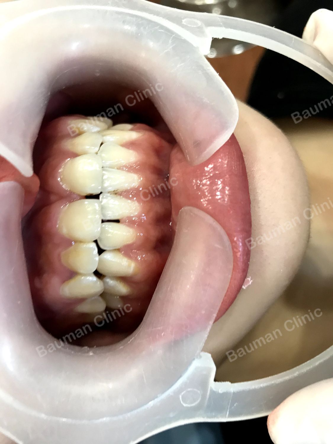 Ca niềng răng số 5012 - Nha khoa Bauman Clinic
