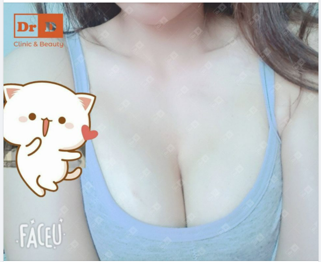 Dáng ngực sẽ ổn định dần và vào form sau khoảng 1 tháng, và đây là feedback kết quả sau 2 tháng các nàng nhé.