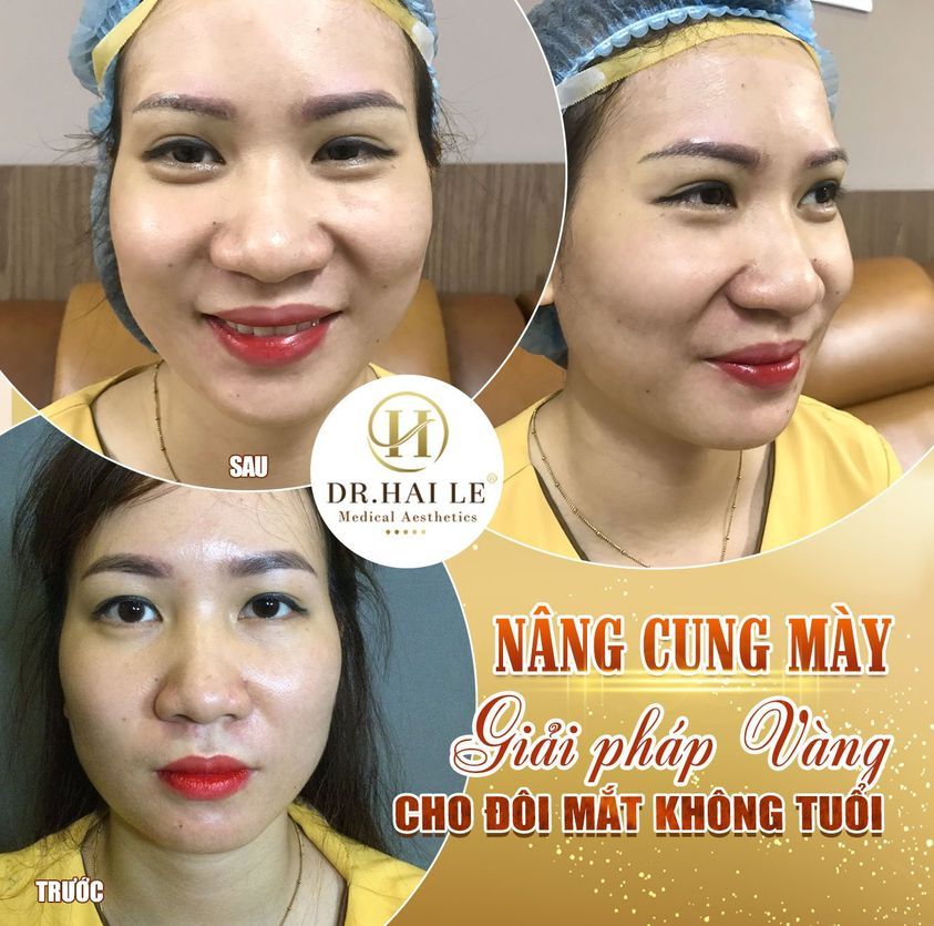 ĐẢO NGƯỢC LÃO HÓA SAU KHI NÂNG CUNG MÀY TẠI DR.HẢI LÊ.