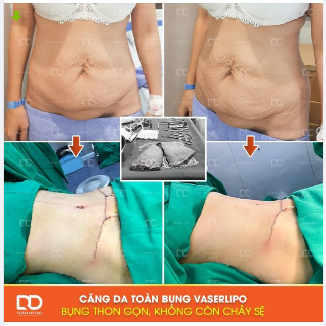 ĐẶT CỌC ONLINE - NHẬN NGAY ƯU ĐÃI Khi thực hiện Công nghệ hút mỡ Vaserlipo