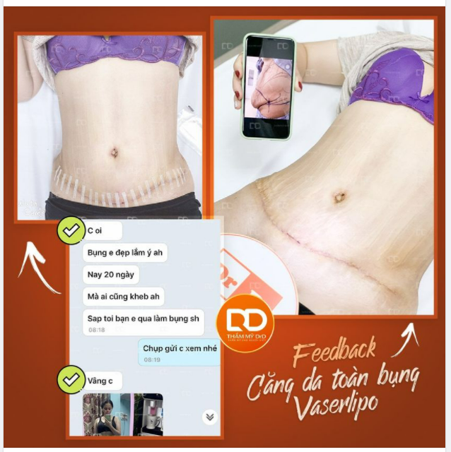DrD chào ngày mới bằng một chiếc feedback sương sương sau phẫu thuật Căng da Vaserlipo