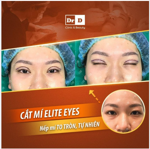 Dù thế nào thì mắt 2 mí vẫn luôn là chuẩn mực về cái đẹp của phụ nữ Á Đông.
