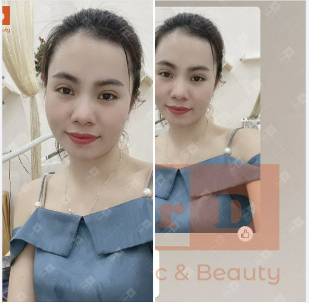 Feedback Cắt mí Elite Eyes không ít mà bác sĩ toàn quên share thôi. Sau 5 ngày sẽ cắt chỉ nhé các nàng.