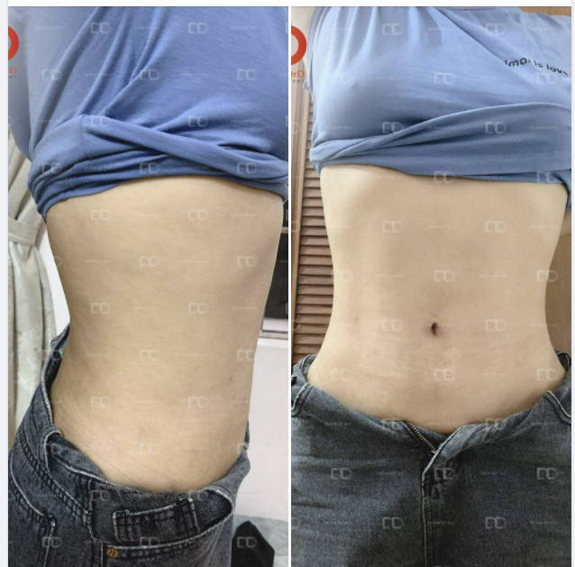 Feedback Hút mỡ toàn bụng VASERlipo - Giảm mỡ thừa triệt để, nhanh gọn mà không để lộ sẹo.