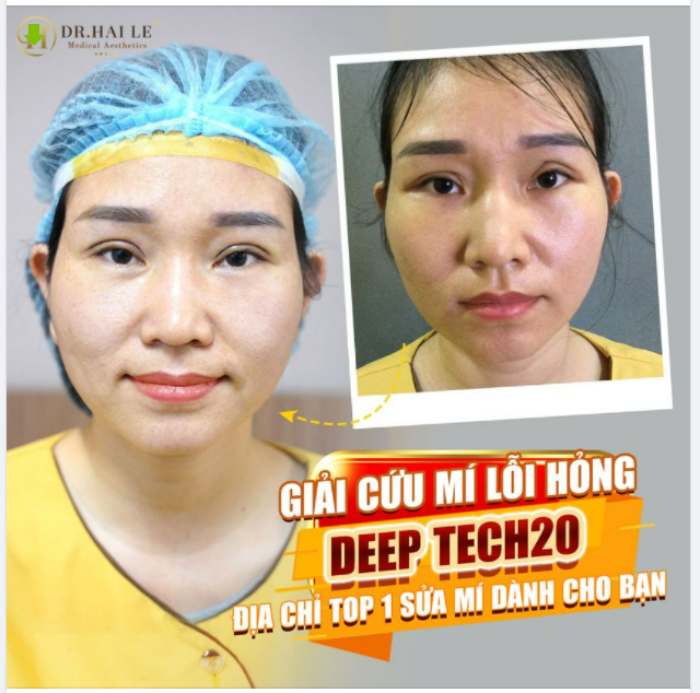 Cùng DEEP TECH20 “TÁI SINH” MÍ ĐẸP - “ĐÁNH BAY” MÍ LỖI, HỎNG