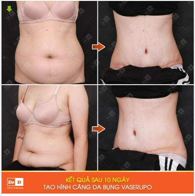 Gác bỏ âu lo bụng thừa mỡ cùng Công nghệ Vaserlipo Chẳng cần làm gì nhiều mà vừa được ăn ngon, lại vừa trông "ngon"