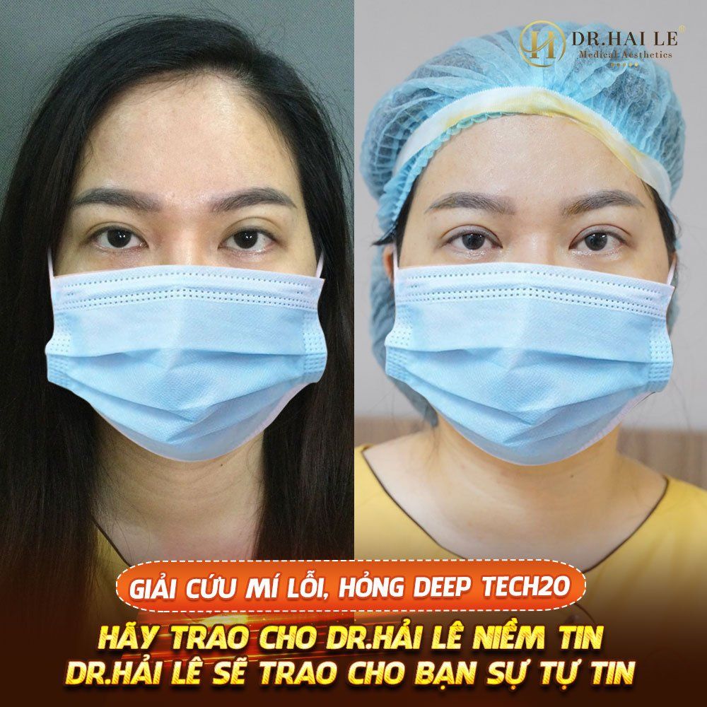 GIẢI CỨU MÍ LỖI, HỎNG DEEP TECH20 - DR.HẢI LÊ TOP 1 SỬA MÍ