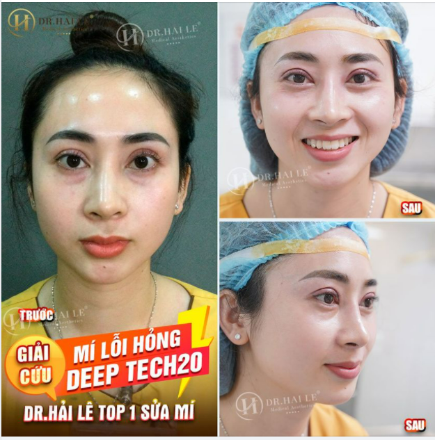 GIẢI CỨU MÍ LỖI, HỎNG DEEP TECH20 - DR.HẢI LÊ TOP 1 SỬA MÍ