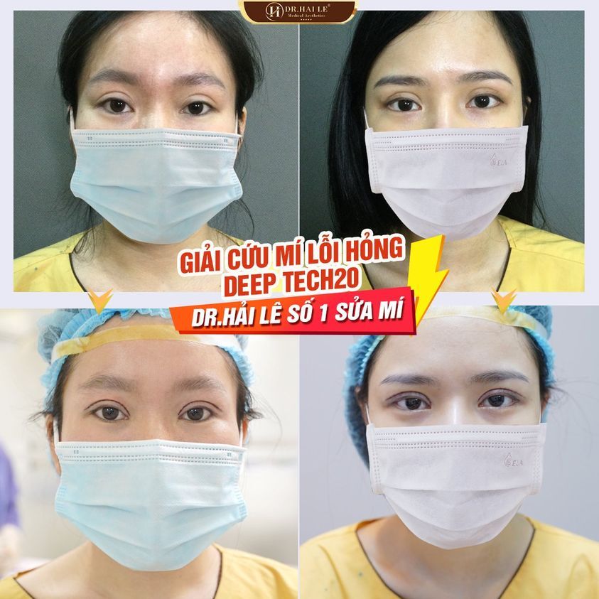 GIẢI CỨU MÍ LỖI, HỎNG DEEP TECH20 - DR.HẢI LÊ TOP 1 SỬA MÍ