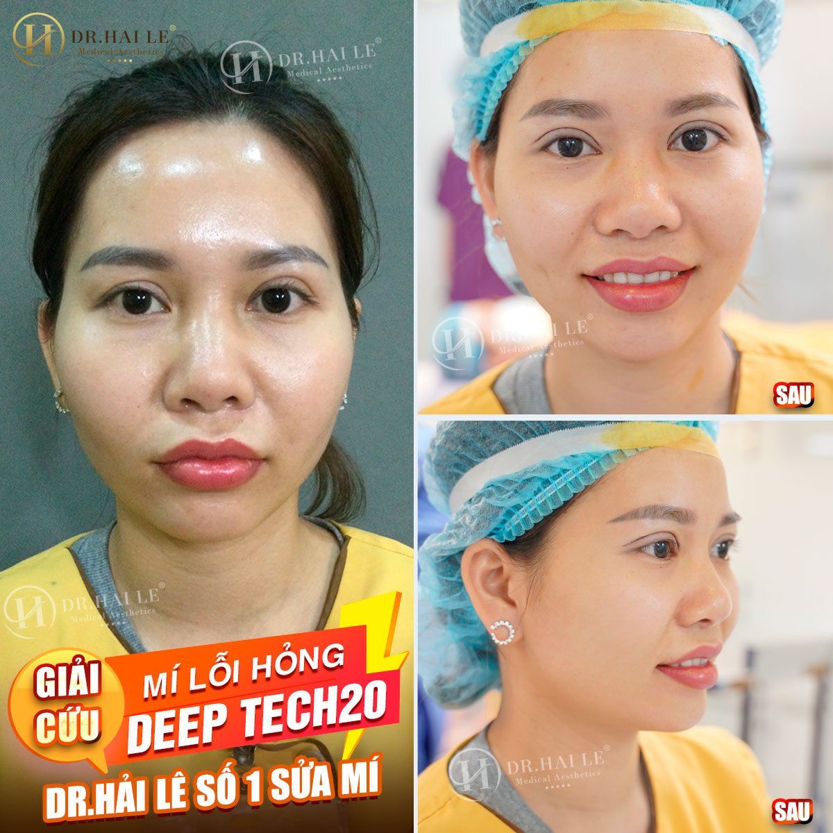 GIẢI CỨU MÍ “XẤU, HỎNG” DEEP TECH20 - DR.HẢI LÊ LÀ TOP 1 SỬA MÍ