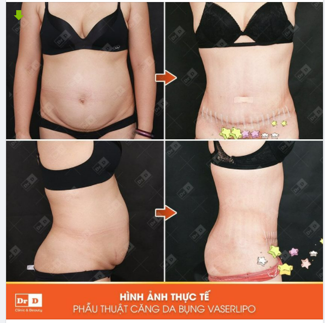 Hình ảnh thực tế của khách hàng sau khi thực hiện phẫu thuật Căng da bụng Vaserlipo