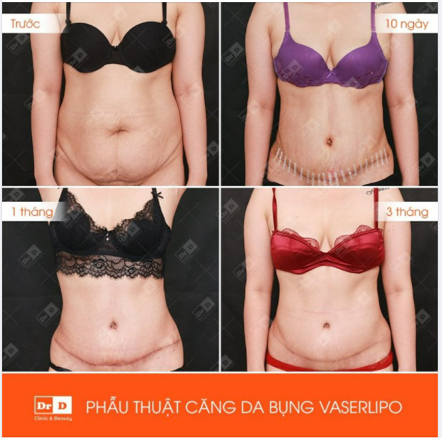 Hình ảnh thực tế kết quả khách hàng thực hiện Căng da toàn bụng Vaserlipo sau 3 tháng thực hiện.