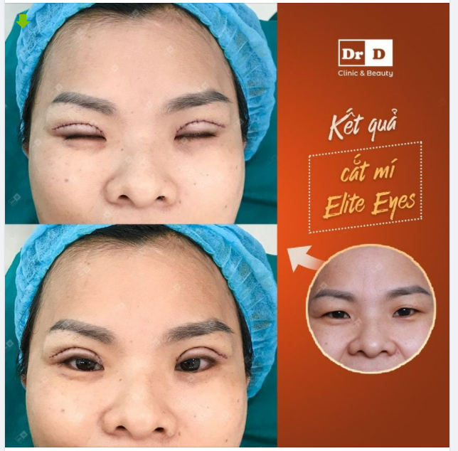 Hình ảnh thực tế khách hàng sau khi thực hiện Cắt mí Elite Eyes