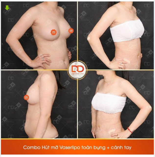 Hình ảnh thực tế khách hàng thực hiện Combo hút mỡ Vaserlipo toàn bụng và cánh tay sau 10 ngày