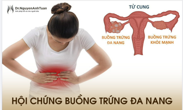 Hội chứng Buồng trứng đa nang