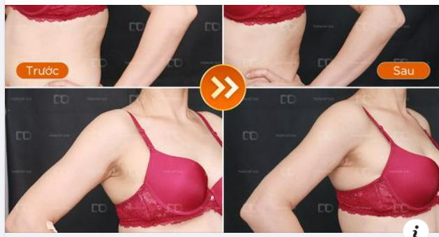 Hút mỡ bắp tay/cánh tay VASERlipo có hiệu quả không?