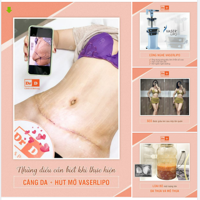 Hút mỡ cũng có công nghệ "this", công nghệ "that" nên đừng vội thực hiện hút mỡ mà chưa tìm hiểu.