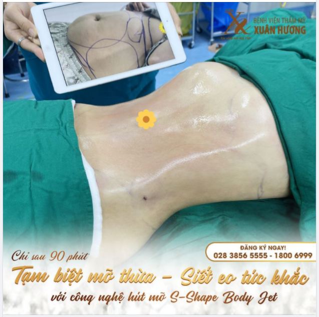 HỦY MỠ THỪA - SIẾT EO THON GỌN CHỈ TRONG 90 PHÚT