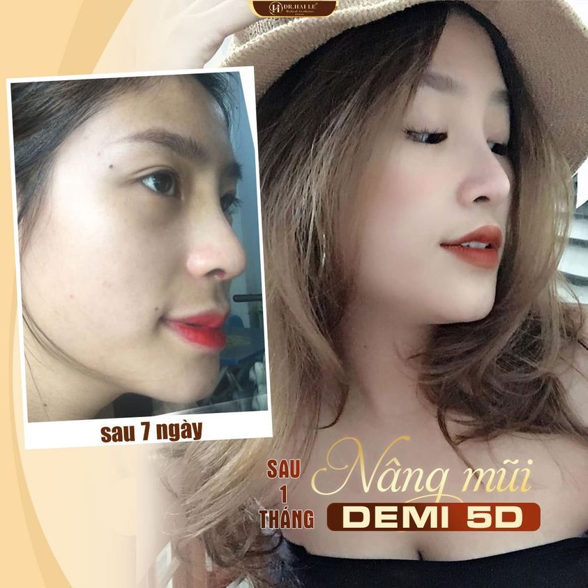 Kết quả Nâng mũi Demi 5D sau 1 tháng