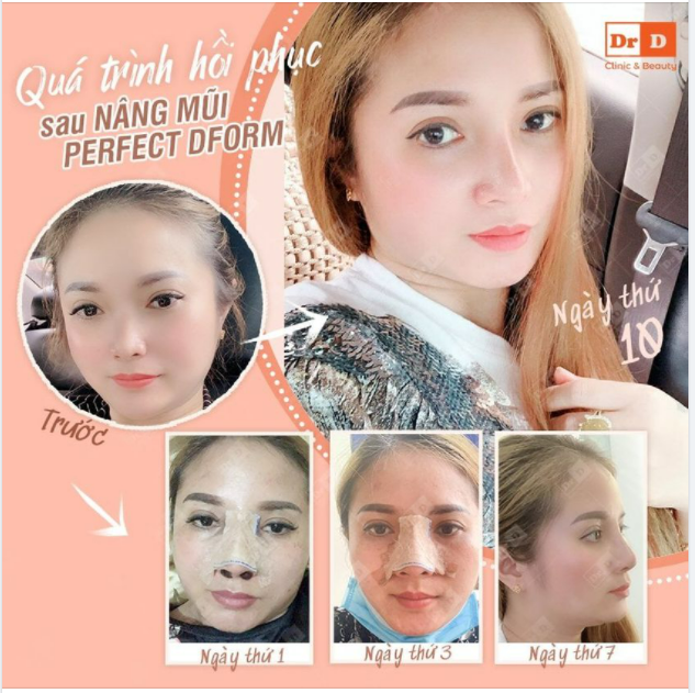 Kết quả phẫu thuật nâng mũi có phụ thuộc vào quá trình chăm sóc hậu phẫu không?