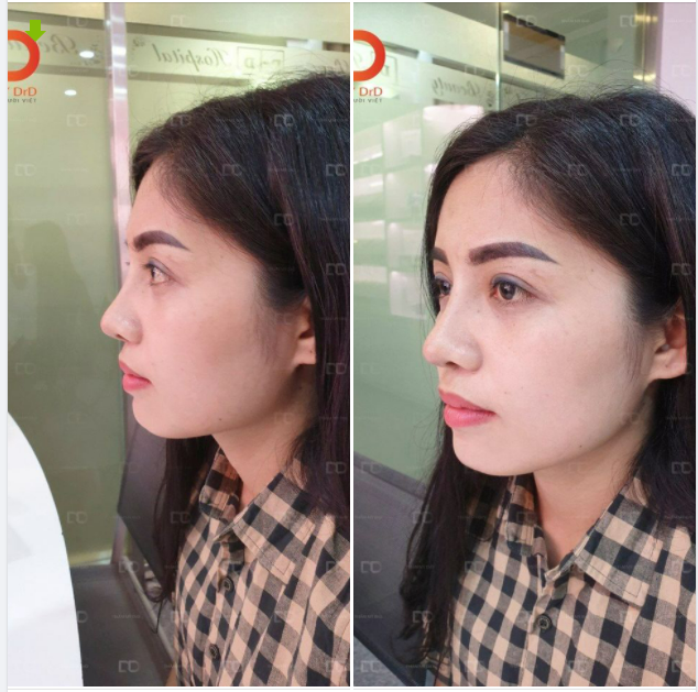 Khách đến thăm khám combo mũi mí sau 1 tháng. Ảnh chụp từ 1 năm trước.