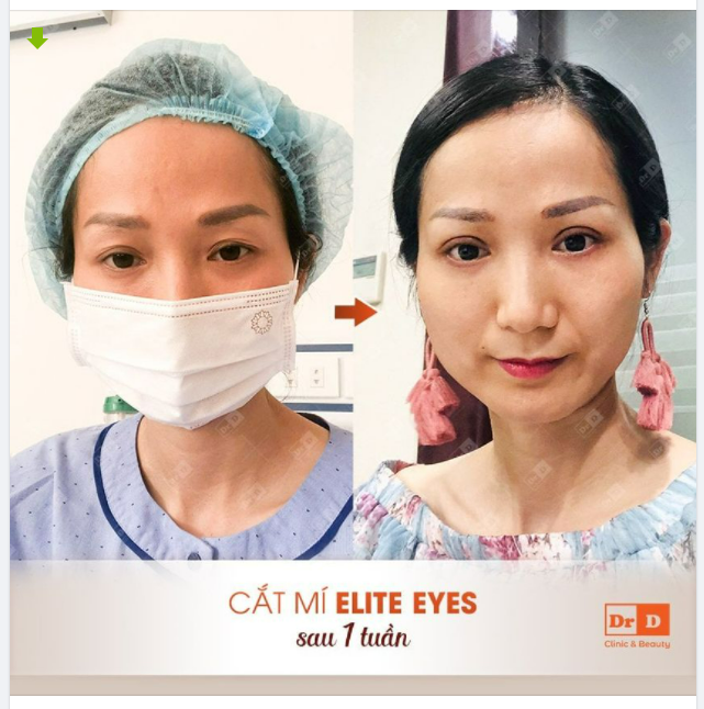 Khách mới gửi feedback Cắt mí Elite Eyes không sưng không đau sau 1 tuần.