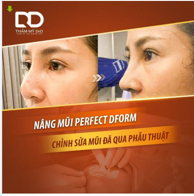 Khi nào có thể sửa lại mũi đã phẫu thuật?