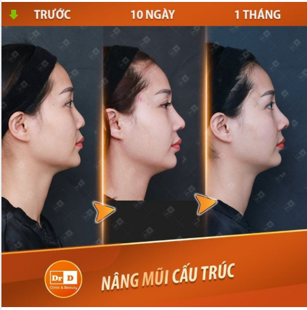 Khi nào nên thực hiện phẫu thuật Nâng mũi cấu trúc?