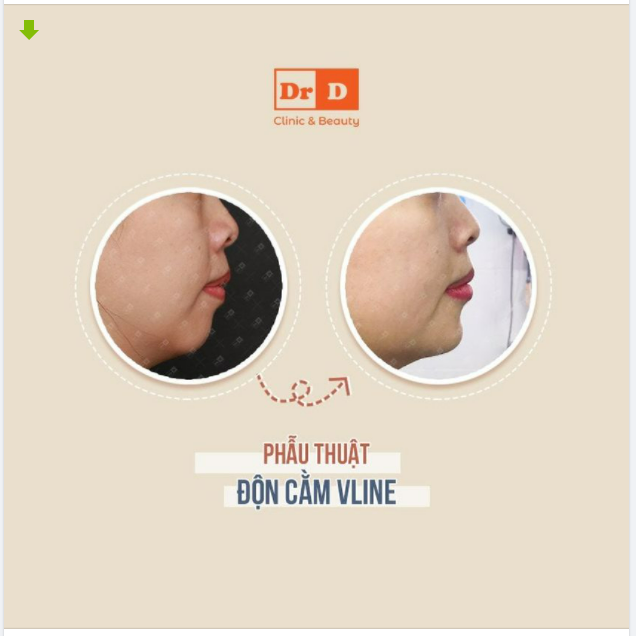 Không phải chỉ có nâng mũi mới tạo nên tỷ lệ vàng cho khuôn mặt. ​​​​​​​ Độn cằm Vline cũng có thể làm được - Khắc phục hoàn toàn tình trạng cằm ngắn, lẹm.