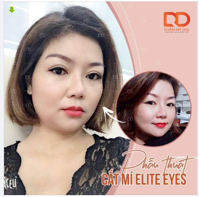 Loại bỏ da chùng - Vùng mắt trẻ hơn tuổi thật