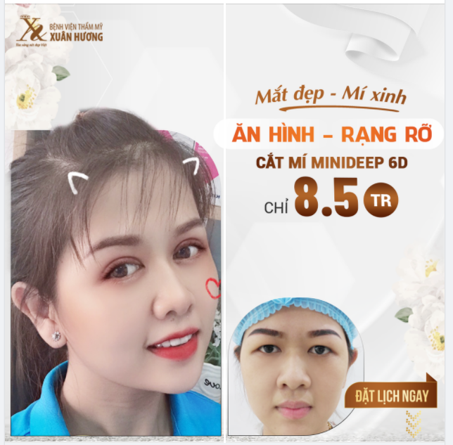 LỢI ÍCH 3IN1 TỪ CẮT MÍ TẠI BVTM XUÂN HƯƠNG