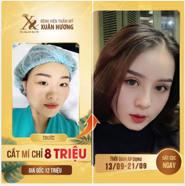MẮT 2 MÍ SẮC NÉT - ĐẸP NGAY SAU 5 NGÀY CHỈ VỚI 8 TRIỆU (giá gốc 12 triệu)