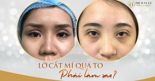 Mí bị quá to sau cắt mí nguyên nhân thường là do lỗi phẫu thuật của bác sĩ, có thể chỉnh sửa được nhưng khá phức tạp!