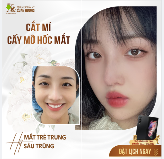 MÍ ĐẸP HÀI HÒA - MẮT HẾT TRŨNG SÂU CHỈ 1 LẦN THỰC HIỆN