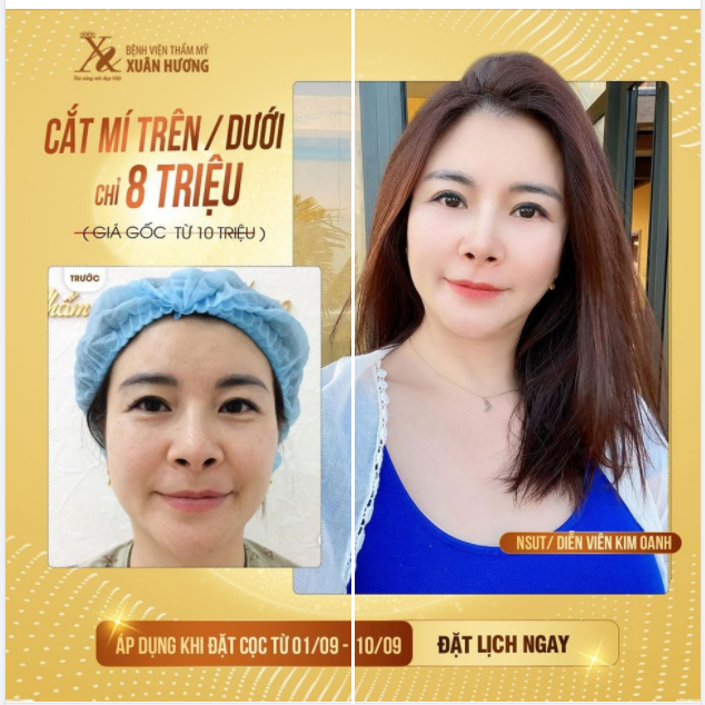 MÍ SẮC NÉT - MẮT TRẺ XINH NSƯT/ DIỄN VIÊN KIM OANH CHỌN CẮT MÍ TẠI BVTM XUÂN HƯƠNG
