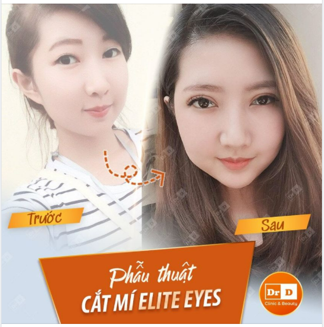 Mũi cao phải đi cùng mắt 2 mí mới chuẩn gu.