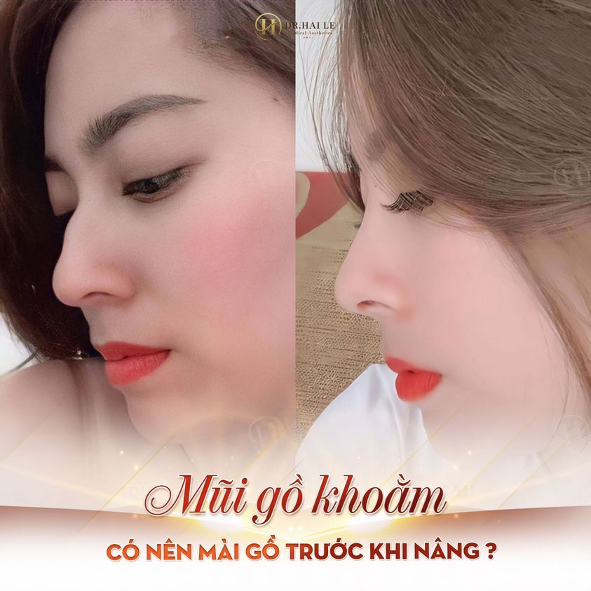 MŨI GỒ - bồ không thích??? MŨI GỒ - tiền đồ xám xịt!!!