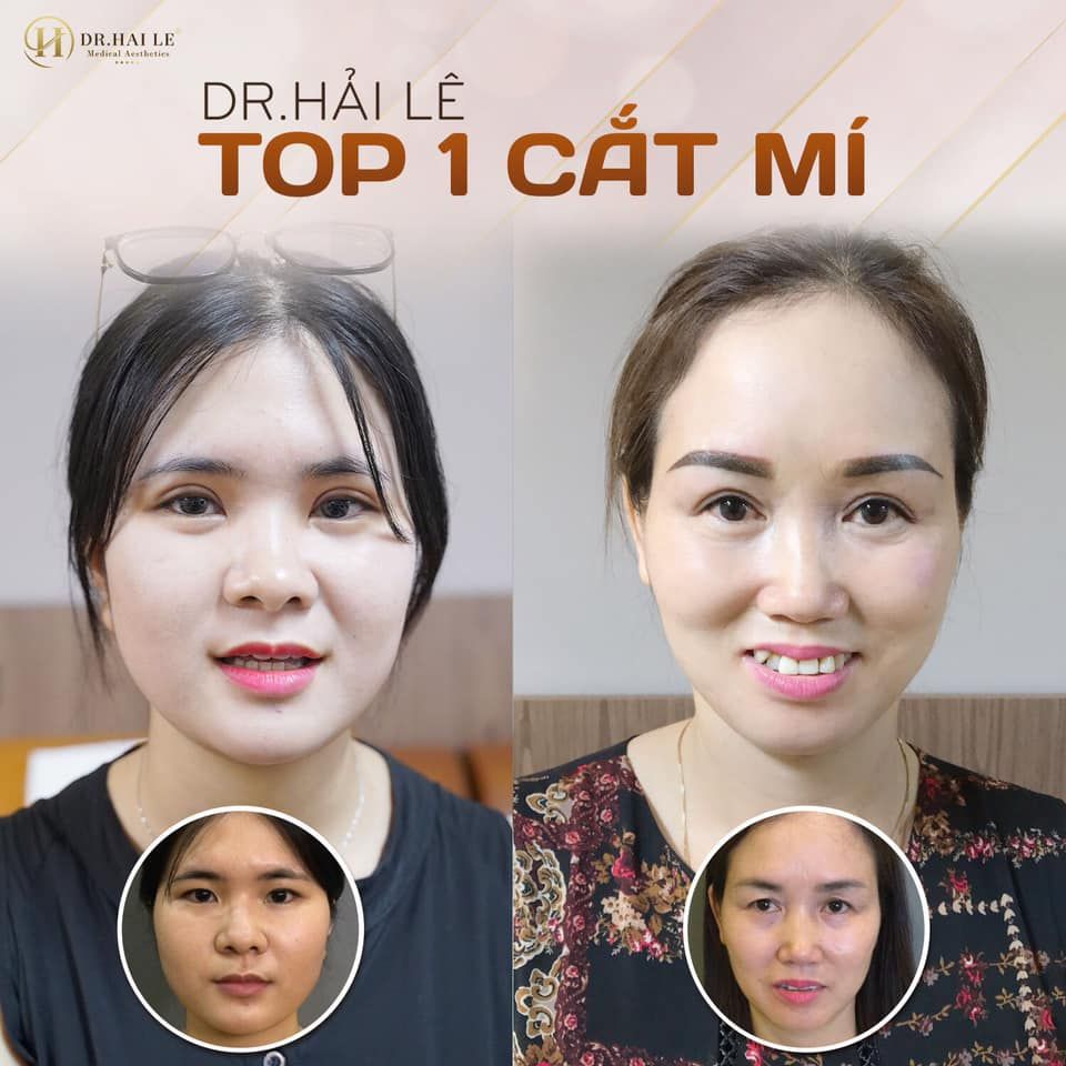 MUỐN CÓ MÍ ĐẸP CHUẨN XINH - ĐẾN NGAY DR.HẢI LÊ.!