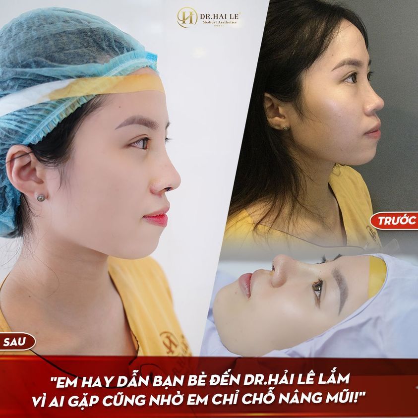 NÂNG MŨI DEMI 5D - Chuẩn nhân trắc học không lo “phá tướng”