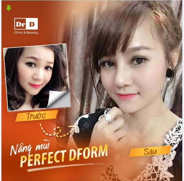 Nâng mũi Perfect Dform có phải bọc đầu mũi không?