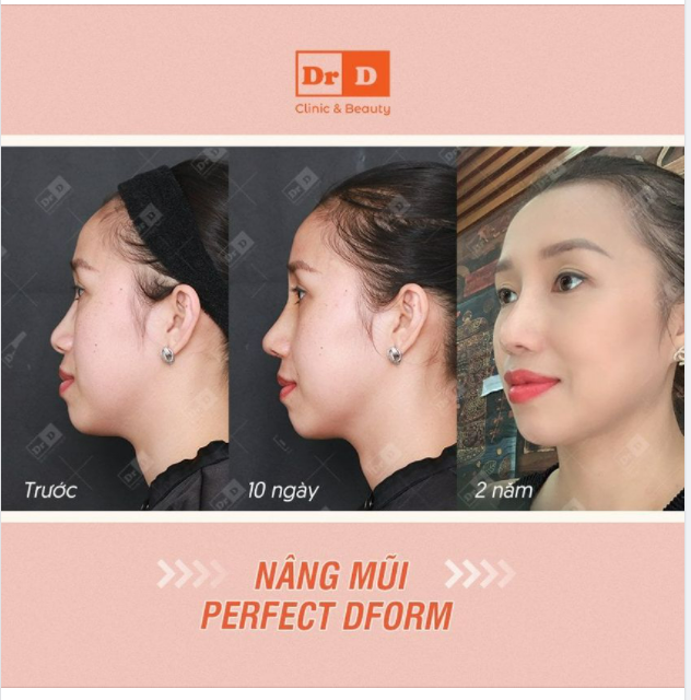 Nâng mũi Perfect Dform duy trì được bao nhiêu lâu?