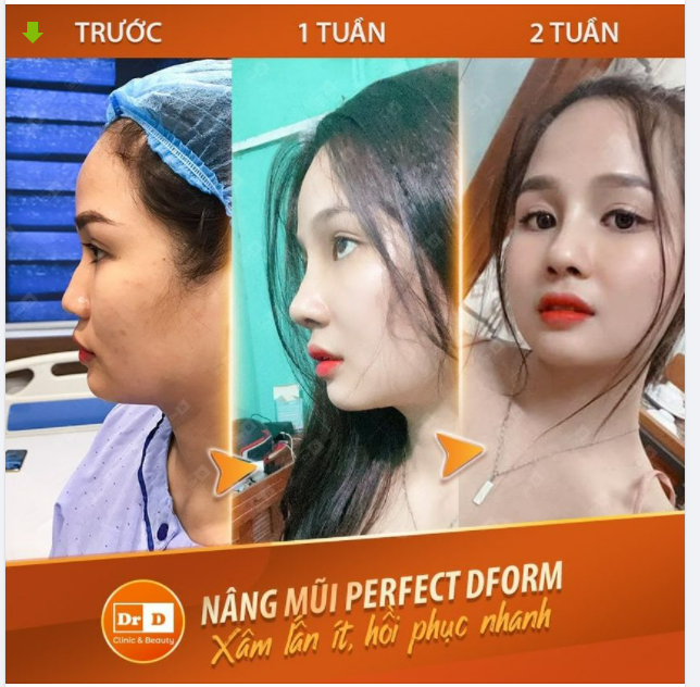 Nâng mũi Perfect Dform không chỉ gói gọn trong kỹ thuật thu gọn đầu mũi mà còn sở hữu kỹ thuật nâng sống mũi cao thanh tú nhưng vẫn đảm bảo độ mềm mại cho dáng mũi.